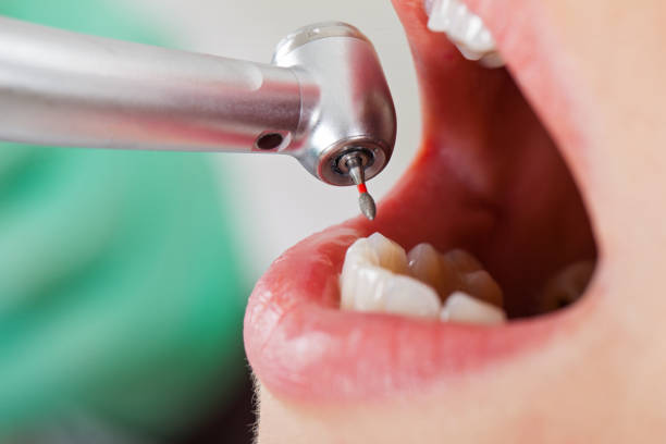 Best Emergency Root Canal Treatment in Cornelius, NC
